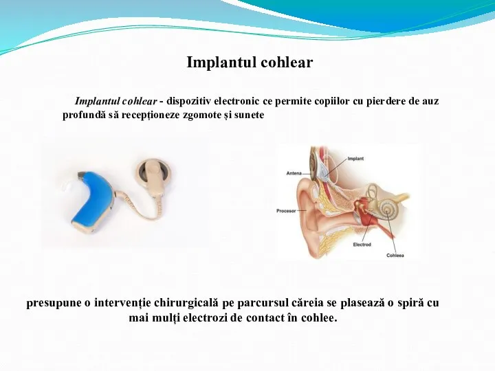 Implantul cohlear Implantul cohlear - dispozitiv electronic ce permite copiilor cu pierdere de