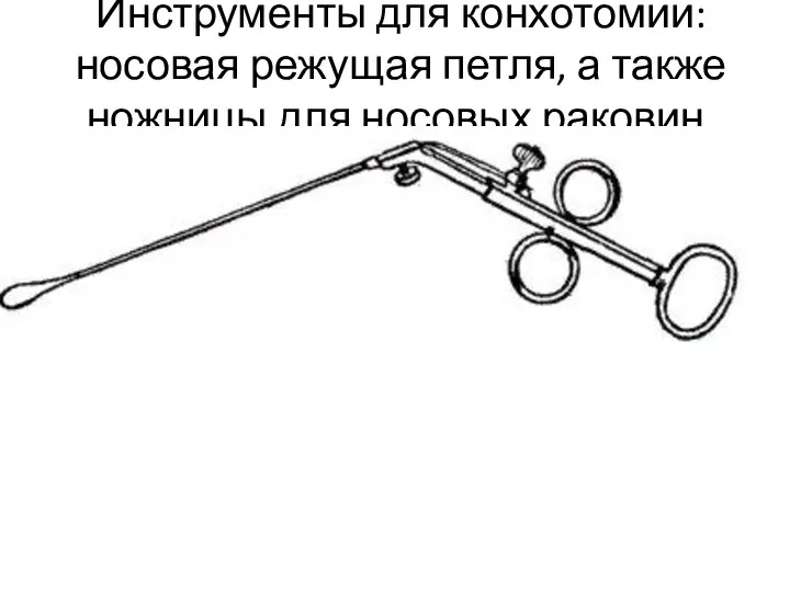 Инструменты для конхотомии: носовая режущая петля, а также ножницы для носовых раковин.