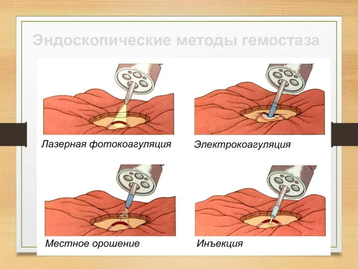 Эндоскопические методы гемостаза