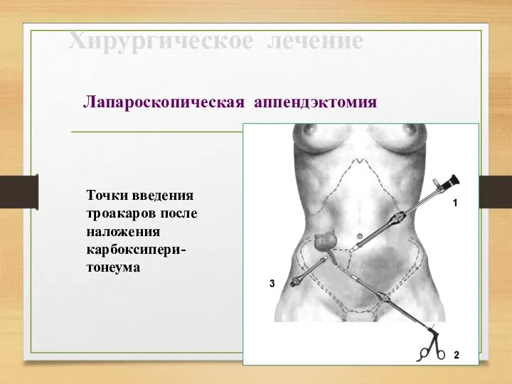 Хирургическое лечение Лапароскопическая аппендэктомия Точки введения троакаров после наложения карбоксипери-тонеума