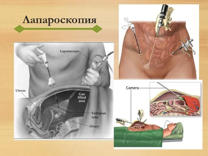 Лапароскопия