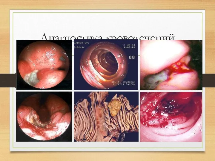 Диагностика кровотечений