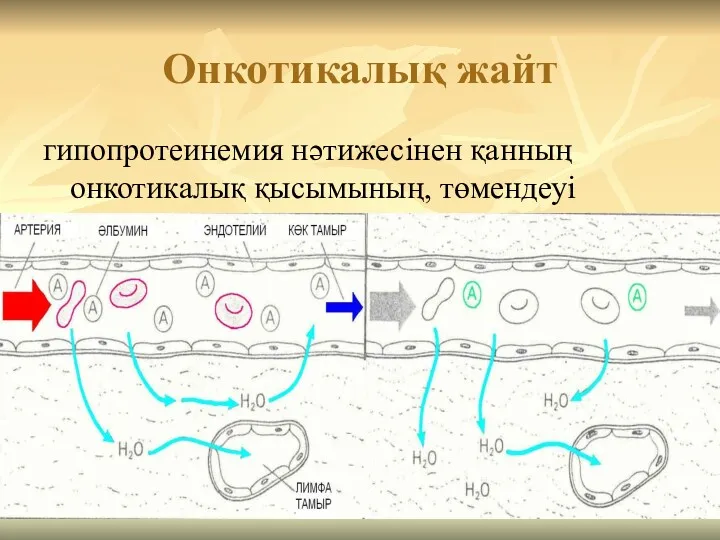 Онкотикалық жайт гипопротеинемия нәтижесінен қанның онкотикалық қысымының, төмендеуі