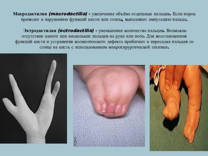 Макродактилия (macrodactilia) - увеличение объёма отдельных пальцев. Если порок приводит