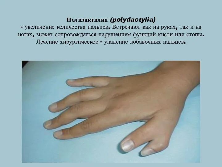 Полидактилия (polydactylia) - увеличение количества пальцев. Встречают как на руках,