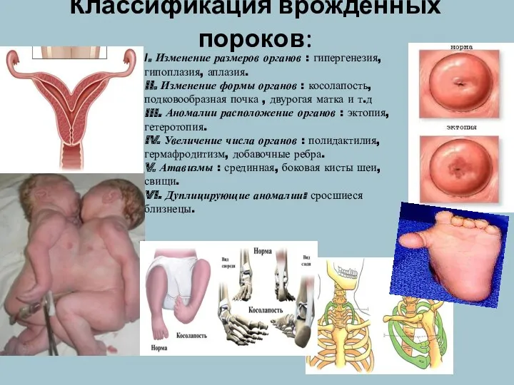 Классификация врожденных пороков: I. Изменение размеров органов : гипергенезия, гипоплазия,