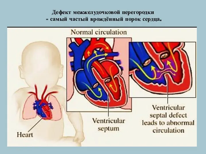 Дефект межжелудочковой перегородки - самый частый врождённый порок сердца.