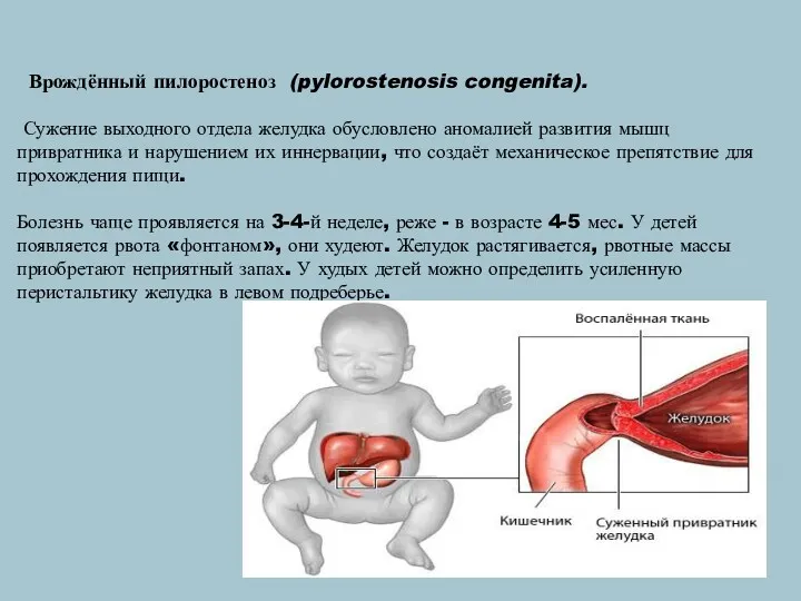 Врождённый пилоростеноз (pylorostenosis congenita). Сужение выходного отдела желудка обусловлено аномалией