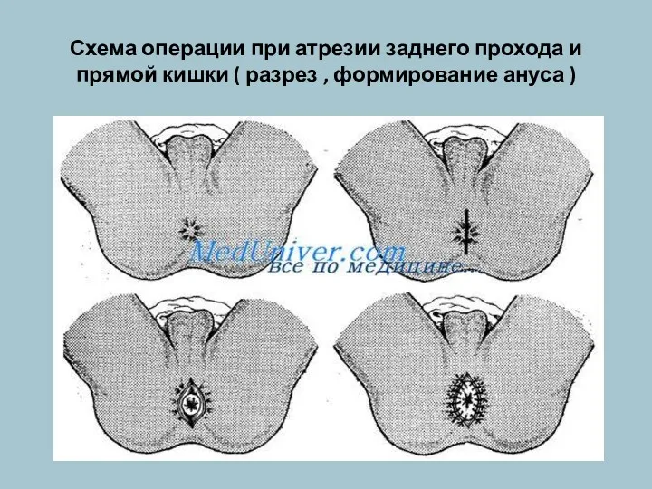 Схема операции при атрезии заднего прохода и прямой кишки ( разрез , формирование ануса )