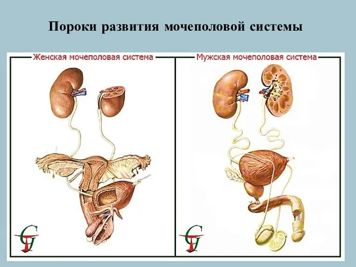 Пороки развития мочеполовой системы