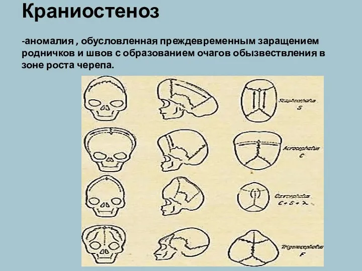 Краниостеноз -аномалия , обусловленная преждевременным заращением родничков и швов с