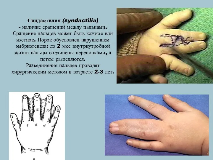 Синдактилия (syndactilia) - наличие сращений между пальцами. Сращение пальцев может