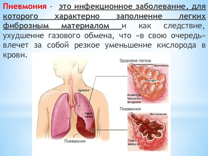 Пневмония - это инфекционное заболевание, для которого характерно заполнение легких