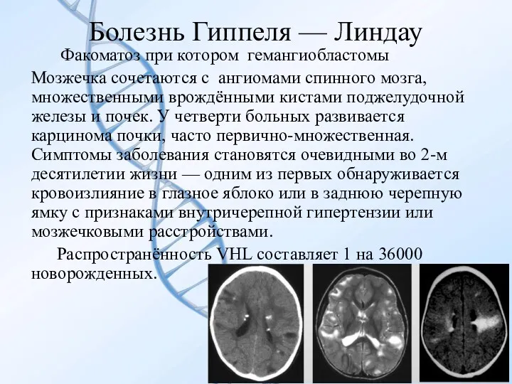 Болезнь Гиппеля — Линдау Факоматоз при котором гемангиобластомы Мозжечка сочетаются
