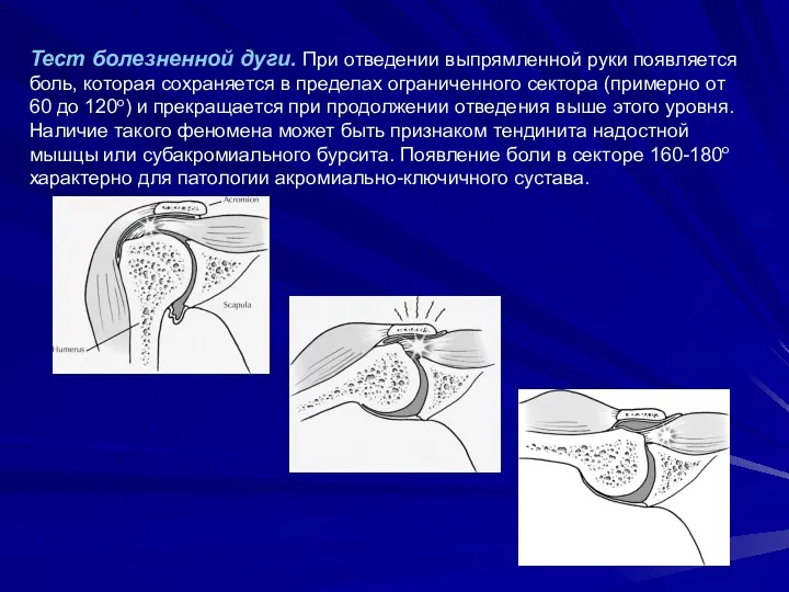 Тест болезненной дуги. При отведении выпрямленной руки появляется боль, которая