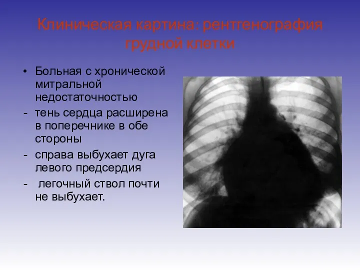 Клиническая картина: рентгенография грудной клетки Больная с хронической митральной недостаточностью