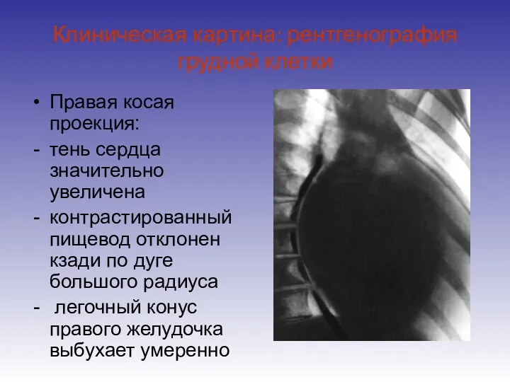 Клиническая картина: рентгенография грудной клетки Правая косая проекция: тень сердца
