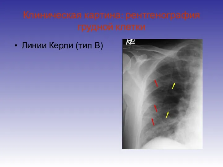 Клиническая картина: рентгенография грудной клетки Линии Керли (тип B)