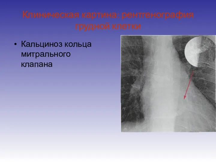 Клиническая картина: рентгенография грудной клетки Кальциноз кольца митрального клапана