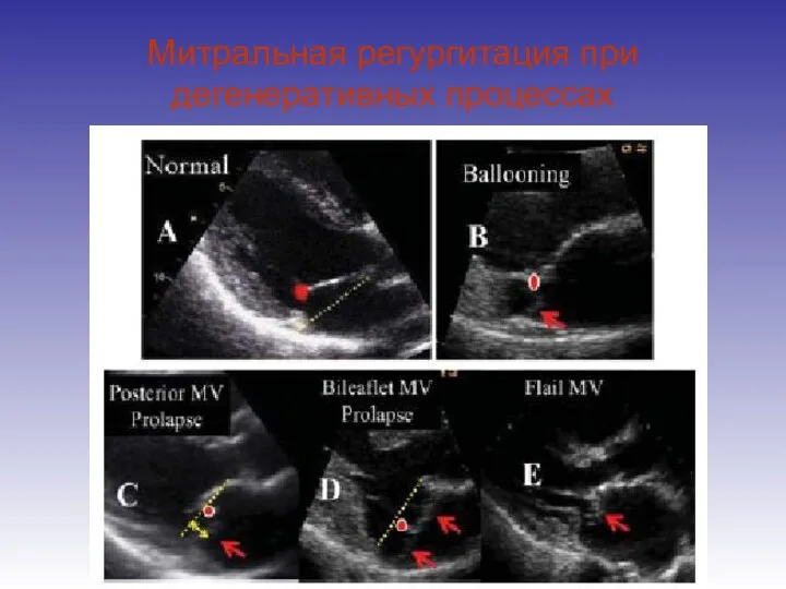 Митральная регургитация при дегенеративных процессах