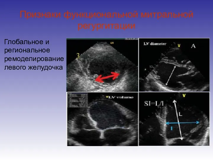 Признаки функциональной митральной регургитации Глобальное и региональное ремоделирование левого желудочка
