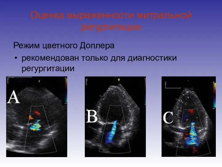 Оценка выраженности митральной регургитации Режим цветного Доплера рекомендован только для диагностики регургитации