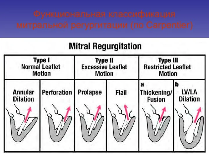 Функциональная классификация митральной регургитации (по Carpentier)