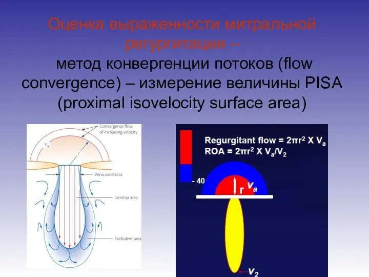 Оценка выраженности митральной регургитации – метод конвергенции потоков (flow convergence)