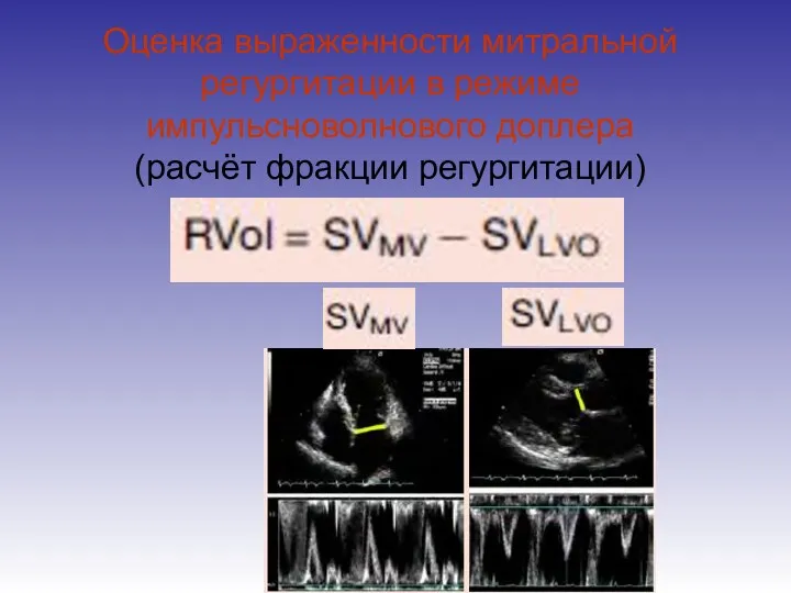 Оценка выраженности митральной регургитации в режиме импульсноволнового доплера (расчёт фракции регургитации)