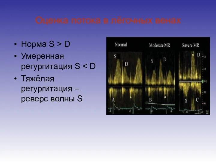 Оценка потока в лёгочных венах Норма S > D Умеренная