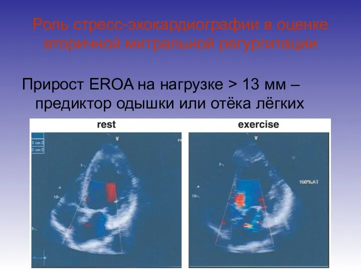 Роль стресс-эхокардиографии в оценке вторичной митральной регургитации Прирост EROA на