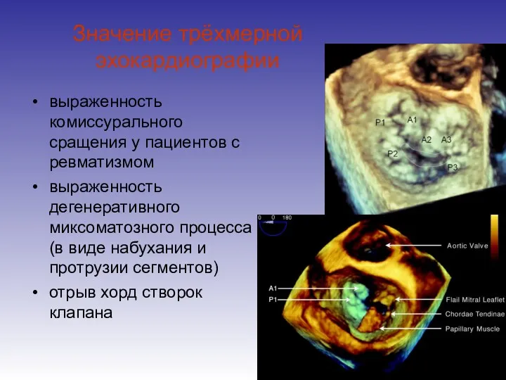 Значение трёхмерной эхокардиографии выраженность комиссурального сращения у пациентов с ревматизмом