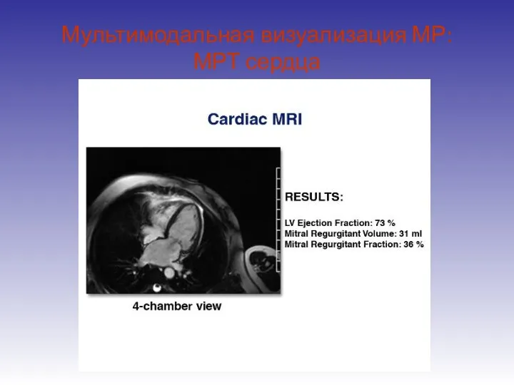 Мультимодальная визуализация МР: МРТ сердца