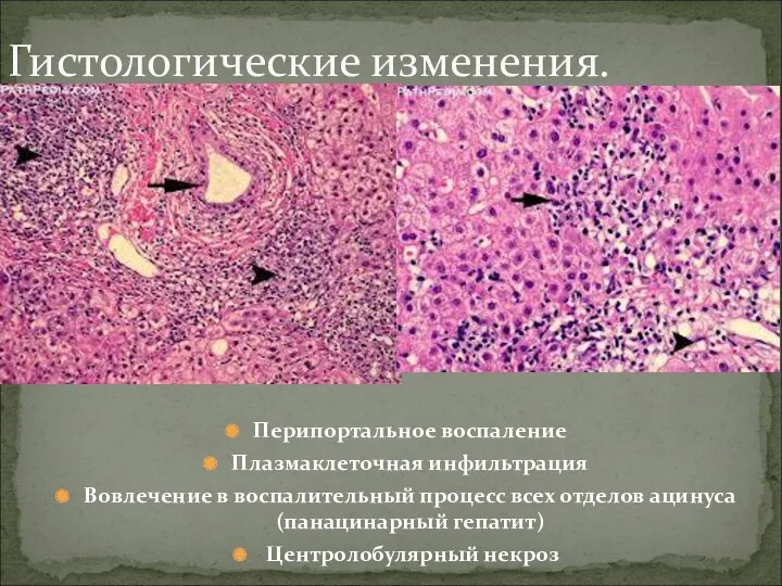 Перипортальное воспаление Плазмаклеточная инфильтрация Вовлечение в воспалительный процесс всех отделов ацинуса (панацинарный гепатит)