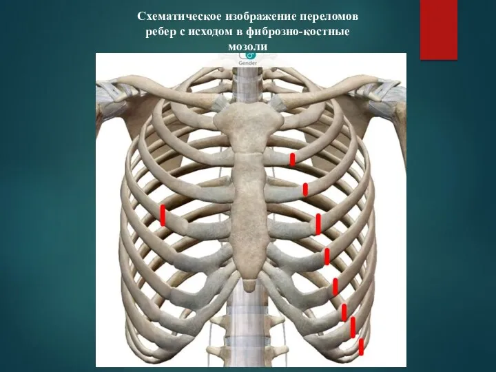 Схематическое изображение переломов ребер с исходом в фиброзно-костные мозоли
