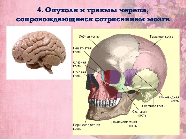 4. Опухоли и травмы черепа, сопровождающиеся сотрясением мозга