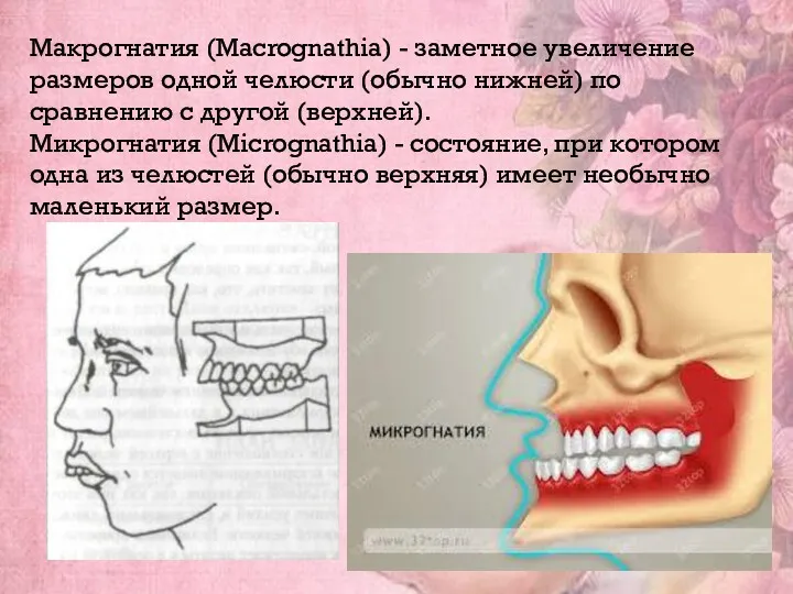 Макрогнатия (Macrognathia) - заметное увеличение размеров одной челюсти (обычно нижней)