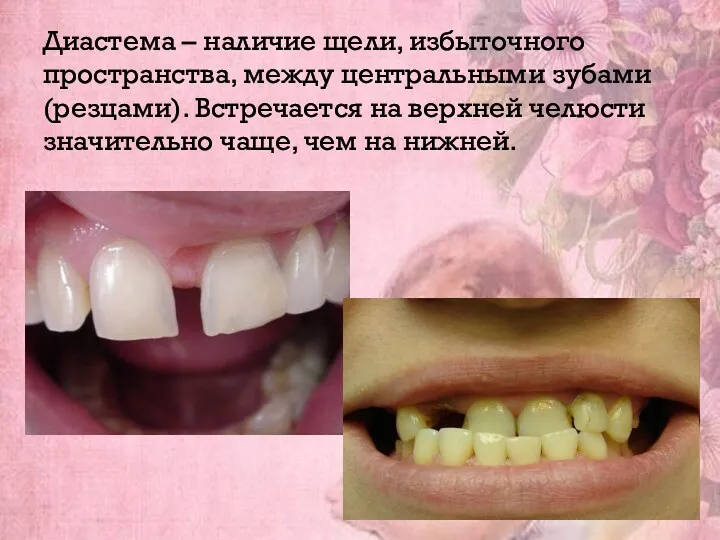 Диастема – наличие щели, избыточного пространства, между центральными зубами (резцами).