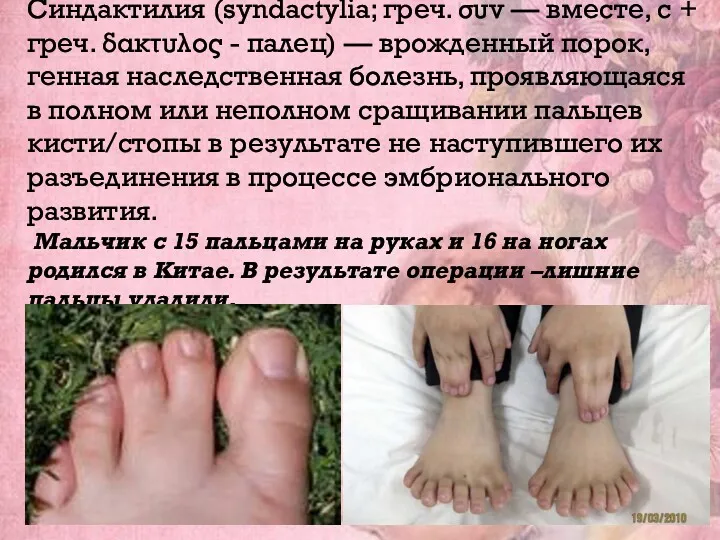 Синдактилия (syndactylia; греч. συν — вместе, с + греч. δακτυλος