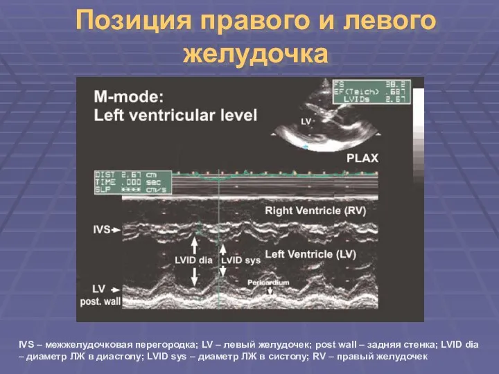 Позиция правого и левого желудочка IVS – межжелудочковая перегородка; LV