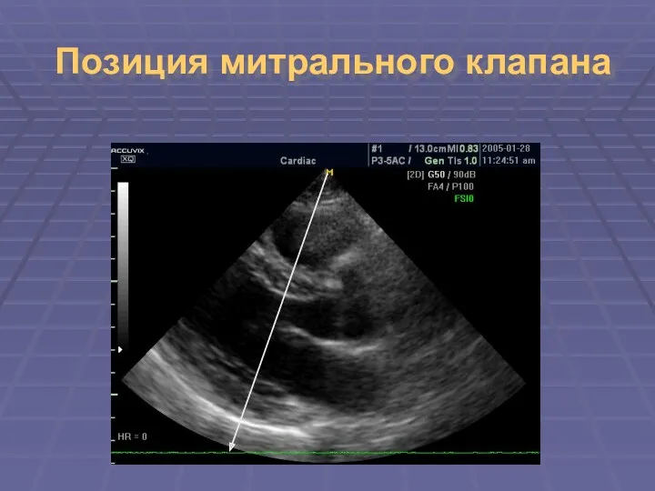 Позиция митрального клапана