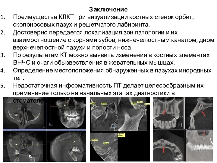 Заключение Преимущества КЛКТ при визуализации костных стенок орбит, околоносовых пазух