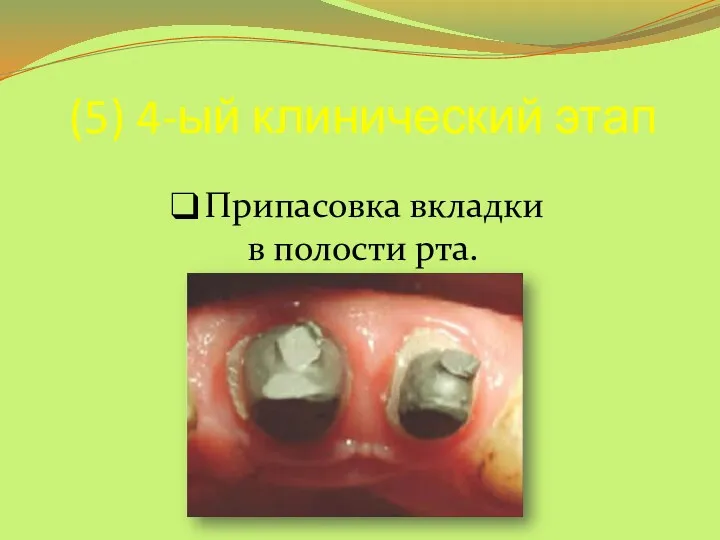 (5) 4-ый клинический этап Припасовка вкладки в полости рта.