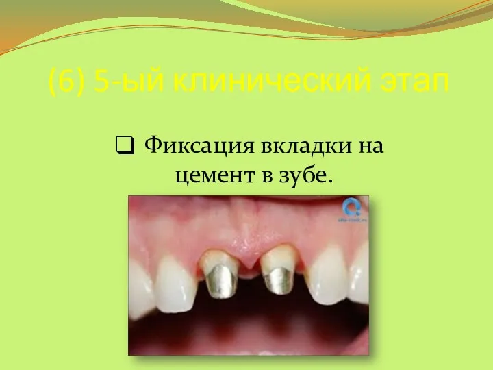 (6) 5-ый клинический этап Фиксация вкладки на цемент в зубе.