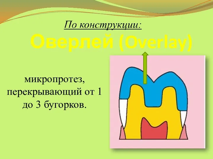 Оверлей (Overlay) микропротез, перекрывающий от 1 до 3 бугорков.