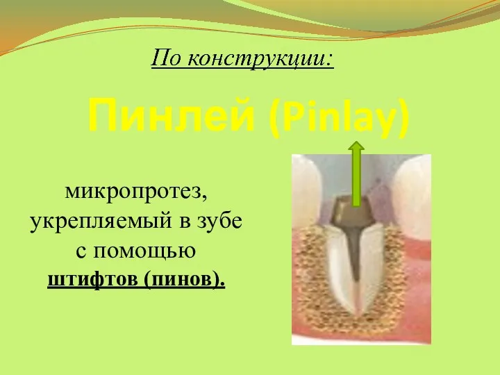 Пинлей (Pinlay) микропротез, укрепляемый в зубе с помощью штифтов (пинов).