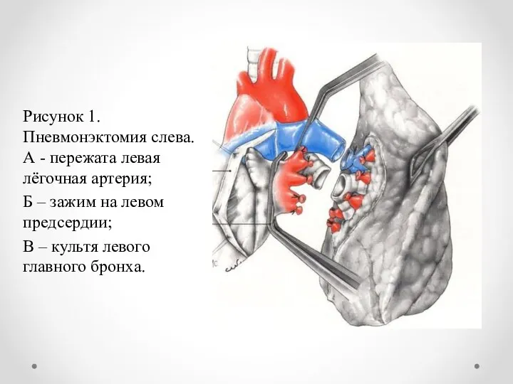 Рисунок 1. Пневмонэктомия слева. А - пережата левая лёгочная артерия; Б – зажим