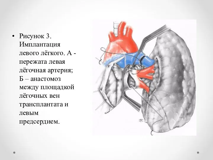 Рисунок 3. Имплантация левого лёгкого. А - пережата левая лёгочная артерия; Б –