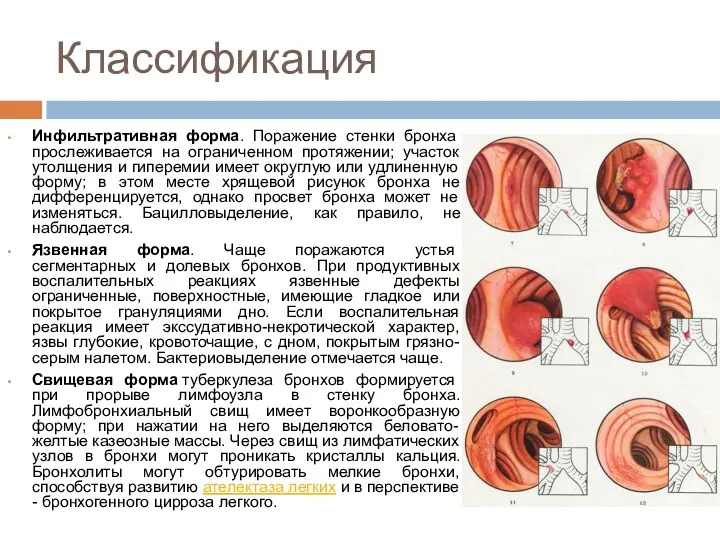 Классификация Инфильтративная форма. Поражение стенки бронха прослеживается на ограниченном протяжении;