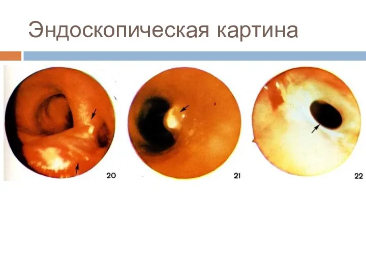 Эндоскопическая картина